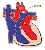 Aortic coarc