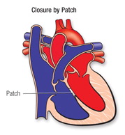 Die opening word met 'n 'patch' toegelap. In sommige gevalle kan dit sonder 'n opehartoperasie gedoen word, maar meestal tydens 'n opehartoperasie.
