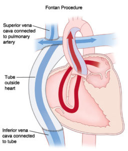 In die derde operasie word die Vena Cava Inferior - die groot aar wat suurstofarm bloed van die onderste deel van die liggaam na die regter-atrium vervoer, afgesny van die regter-atrium en met ‘n kunsbuis ook regstreeks aan die longslagaar verbind. Nou vloei alle suurstofarm bloed regstreeks na die longe, en beland net suurstofryke bloed in die regteratrium en dus die regterventrikel.