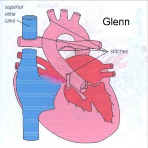 glenn-shunt