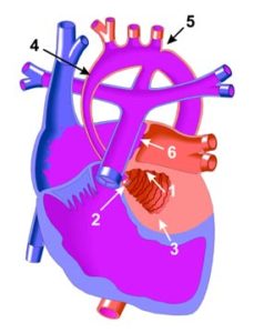 Amy is met hipoplastiese linkerventrikel gebore. Dit beteken haar linkerventrikel (1) was baie klein al was die spierwand (3) baie dik. Die stygende deel van die aorta (4) was baie onderontwikkeld. Omdat die linkerventrikel nie ontwikkel nie, ontwikkel die mitrale klep (2) tussen die linkeratrium en linkerventrikel ook nie. In baie gevalle bly die fetale opening (5) tussen die aorta en longslagaar oop, en is die aorta ook by dié plek vernou (dit is bekend as koarktasie van die aorta.)