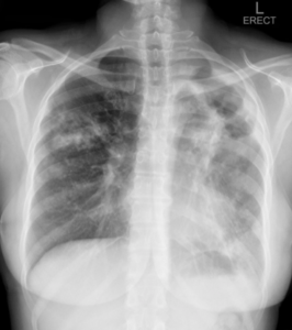 Aan die regterkant vroeë volwasse tipe tuberkulose infiltrate in die long en aan die linkerkant ‘n long met groot holtes (cavities) waar die meeste TB bakterieë groei