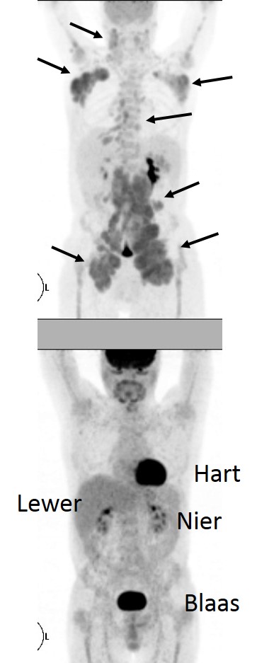 limfoom-fdg-complete-remission