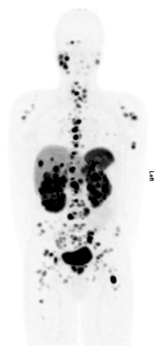 prostaat-mip-ga-68-psma