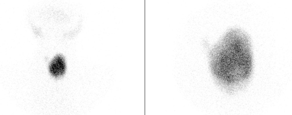 skildklier-warm-nodule