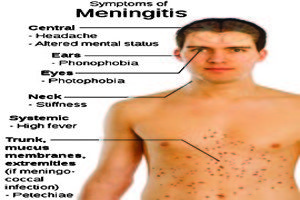 Graphics_Symptoms_of_Meningitis-2