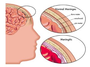 meningitis