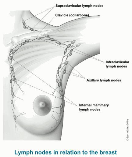 Die limfnodes om die bors. As minder as drie nodes aangetas is, word die kanker nog in vroeë stadium beskou.