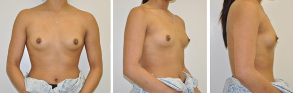 In al meer gevalle word tepelbehoudende chirurgie ingespan wanneer ‘n knop verwyder word. Die resultate is medies en esteties goed.