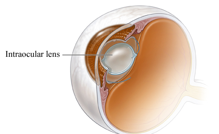 Wat is katarakte en hoe werk lens-inplantings?