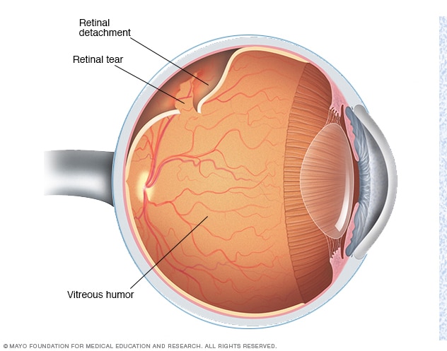 Retinale loslating MOET onmiddellik behandel word