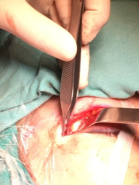 Transorbitale chirurgie 10