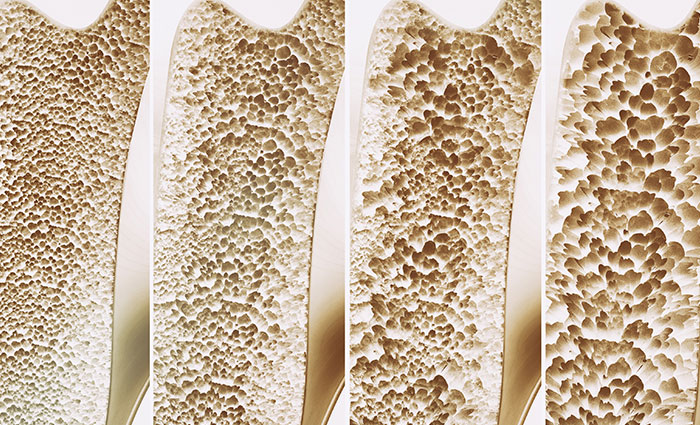 Ongesonde leefstyl in tienerjare help osteoporose in later jare aan