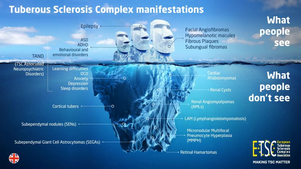 Tubereuse sklerose, die rare siekte wat behandeling vir ander genetiese siektes kan ontsluit